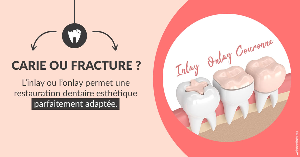 https://docteur-alexandre-benoit-lentrebecq.chirurgiens-dentistes.fr/T2 2023 - Carie ou fracture 2