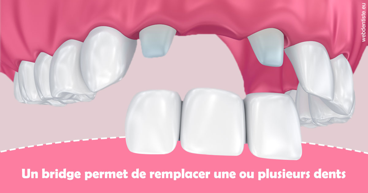 https://docteur-alexandre-benoit-lentrebecq.chirurgiens-dentistes.fr/Bridge remplacer dents 2