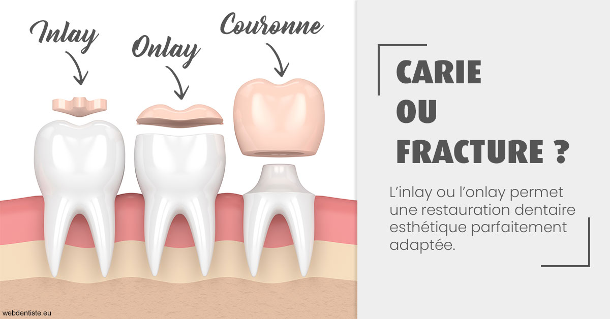 https://docteur-alexandre-benoit-lentrebecq.chirurgiens-dentistes.fr/T2 2023 - Carie ou fracture 1