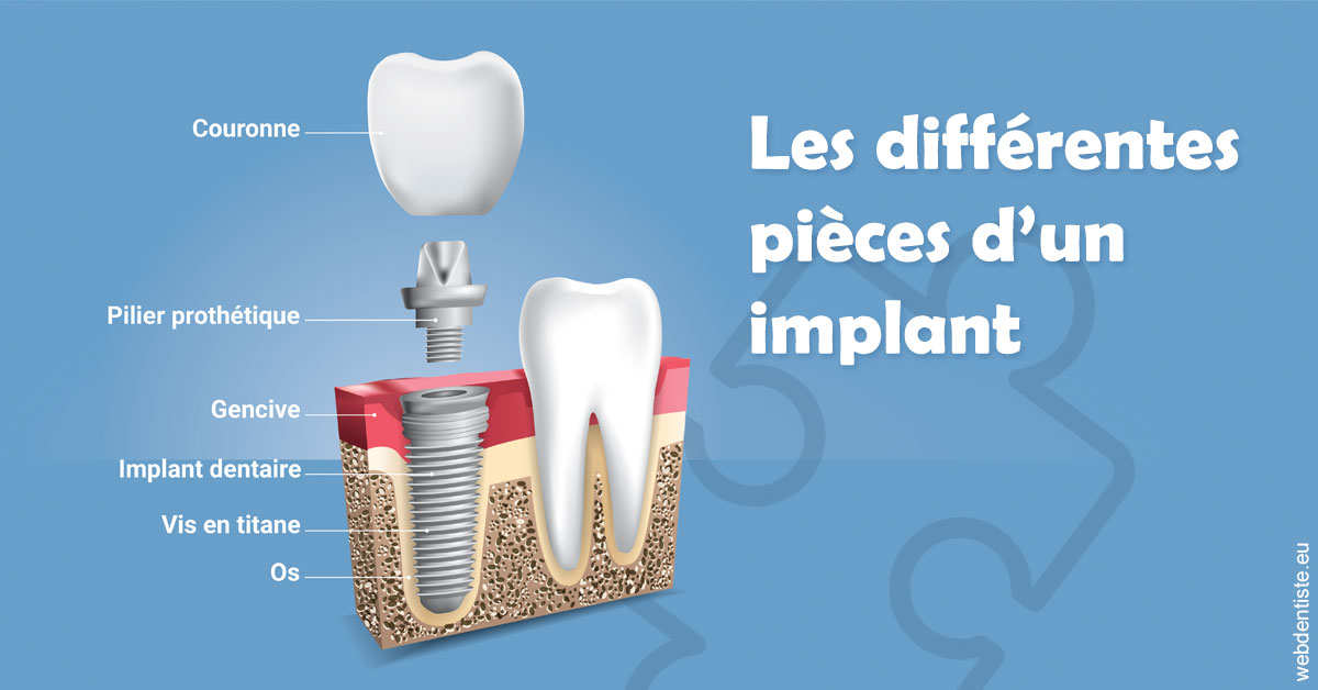 https://docteur-alexandre-benoit-lentrebecq.chirurgiens-dentistes.fr/Les différentes pièces d’un implant 1